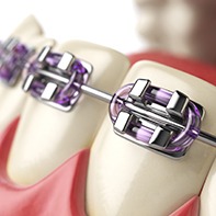 Canfield Traditional Braces | Bracket & Wire Orthodontics | Orthodontist