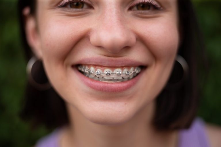 Busting 6 Common Myths About Metal Braces Mikolich Orthodontics