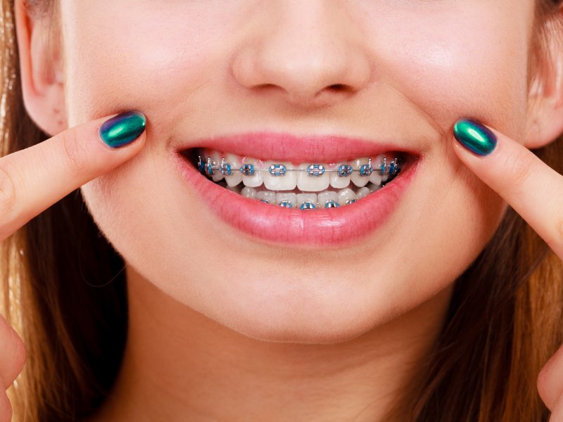 patient pointing to their braces 